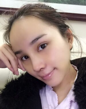 隆鼻整形+硅膠墊下巴前后對比照片給大家瞅瞅