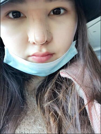 我的隆鼻整形恢復(fù)那些小事