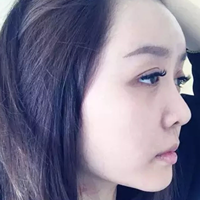 玻尿酸注射隆鼻、自體脂肪豐太陽(yáng)穴跟玻尿酸墊下巴兩個(gè)月果照片~