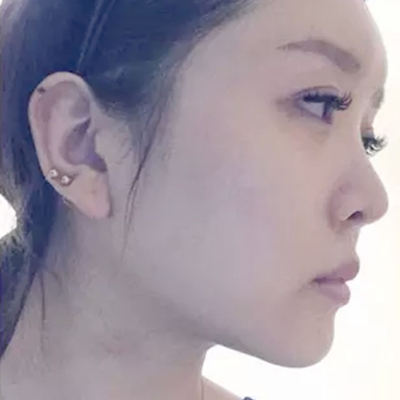 玻尿酸注射隆鼻、自體脂肪豐太陽(yáng)穴跟玻尿酸墊下巴兩個(gè)月果照片~