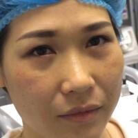 去眼袋手術(shù)多少錢？做了激光去眼袋價(jià)格5800元，恢復(fù)很好