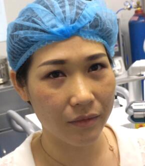 剛做完去眼袋手術(shù)照片