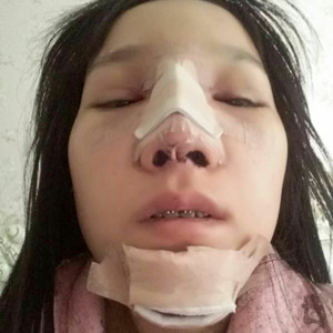 做了假體隆鼻+下巴，簡直是丑女大翻身啊