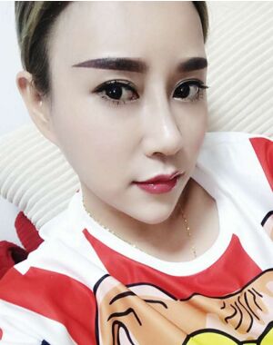 牛永敢做的隆鼻失敗修復(fù)，對比很明X哦~