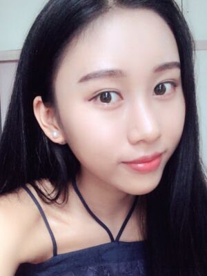 自體脂肪全臉填充變化特別大，臉型更精致了