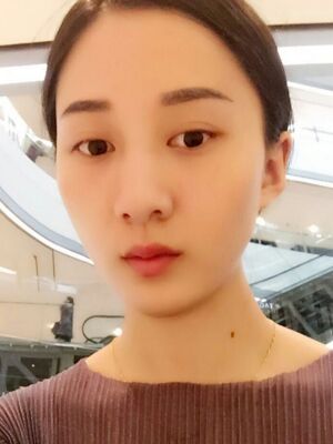 激光祛斑前后對比圖，雀斑全都沒啦