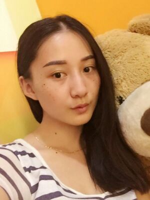 激光祛斑前后對比圖，雀斑全都沒啦