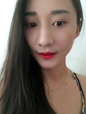 激光祛斑前后對比圖，雀斑全都沒啦