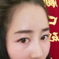 自體脂肪填充太陽穴豐額頭親身經(jīng)歷，多過程恢復圖分享