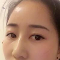 自體脂肪填充太陽穴豐額頭親身經(jīng)歷，多過程恢復圖分享