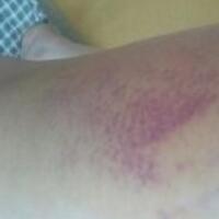 水動力吸脂減肥瘦大腿真實經(jīng)歷，抽脂后對比照片分享