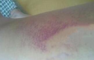 水動力吸脂減肥瘦大腿前面一周恢復過程有些辛苦