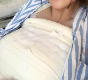 假體隆胸