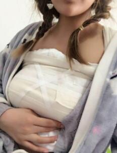 曼托假體隆胸手術(shù)后第五天