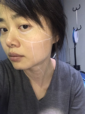 做了高強度聚焦超聲，果還不錯，想把經(jīng)歷分享給大家