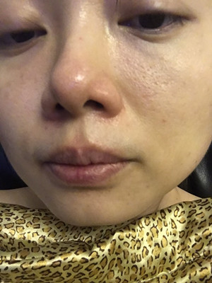 做了高強度聚焦超聲，果還不錯，想把經(jīng)歷分享給大家