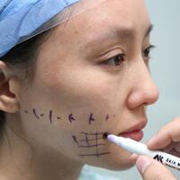 蛋白線面部埋埋蛋白線.提升手術(shù)價(jià)格15000元，果不錯(cuò)分享給大家