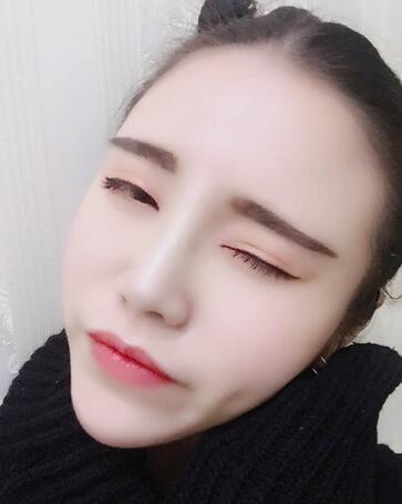 耳軟骨墊鼻尖一個月圖