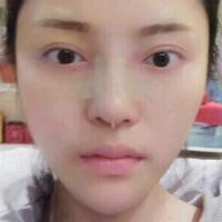 假體隆鼻15天后恢復(fù)圖，隆鼻果自然