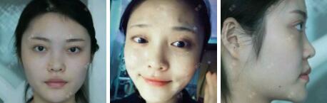 假體隆鼻15天后恢復圖,隆鼻果自然