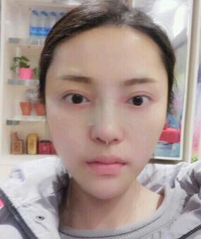 假體隆鼻15天后恢復圖,隆鼻果自然