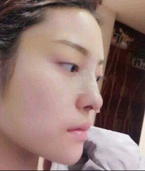 假體隆鼻15天后恢復圖,隆鼻果自然