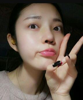 假體隆鼻15天后恢復圖,隆鼻果自然