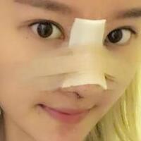 硅膠假體隆鼻過程和隆鼻前后圖片，真實案例分享