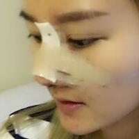 硅膠假體隆鼻過程和隆鼻前后圖片，真實案例分享