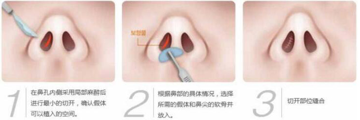 硅膠假體隆鼻過程和隆鼻前后圖片,真實(shí)案例分享