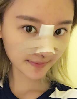 硅膠假體隆鼻過程和隆鼻前后圖片,真實(shí)案例分享