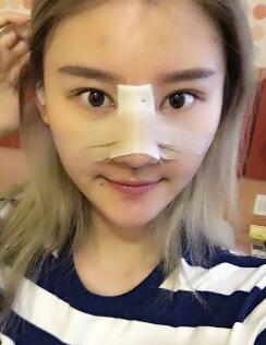 硅膠假體隆鼻過程和隆鼻前后圖片,真實(shí)案例分享