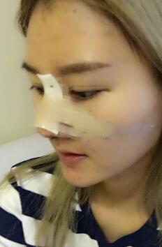 硅膠假體隆鼻過程和隆鼻前后圖片,真實(shí)案例分享