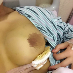 50000元做的自體脂肪隆胸，還有前后對比照片以及注意事項哦