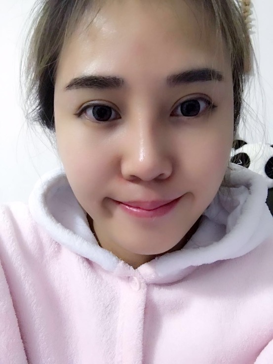 長沙華韓華美做的隆鼻整形，感覺果還不錯哦!