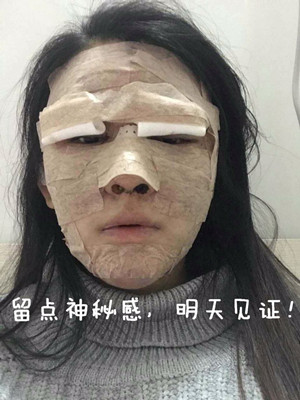 做了詳細(xì)部脂肪填充+雙眼皮+假體隆鼻，來(lái)看看果如何