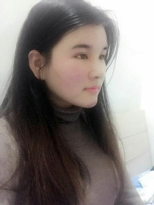 做了詳細(xì)部脂肪填充+雙眼皮+假體隆鼻，來(lái)看看果如何