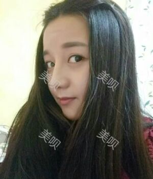 韓式隆鼻整形真實(shí)恢復(fù)期圖片，自然不夸張