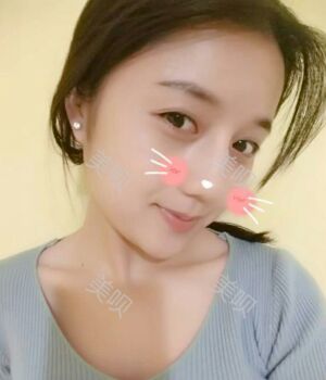韓式隆鼻整形真實(shí)恢復(fù)期圖片，自然不夸張