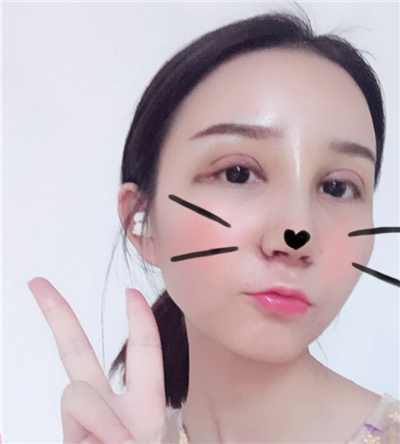 寧波薇琳張宗學(xué)眼部綜合整形案例