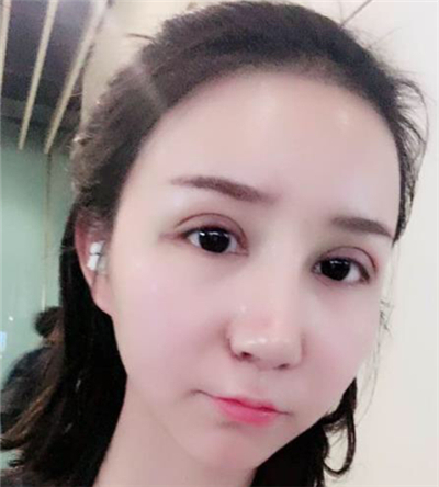 寧波薇琳張宗學(xué)眼部綜合整形案例