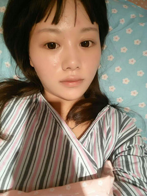 做完自體脂肪豐胸手術(shù)3個月啦!來看看前后對比照片哦