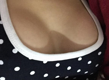 我的假體豐胸逆襲之路  親身體驗(yàn)