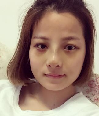 鼻子整形拆線