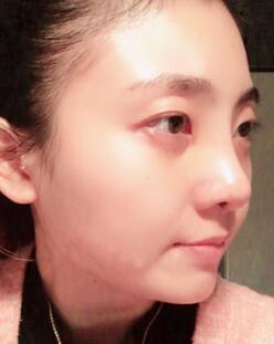鼻子整形過程恢復(fù)圖片,真實(shí)案例分享