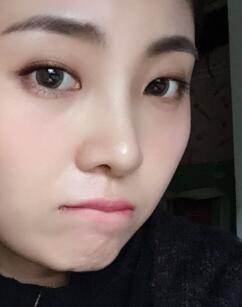 鼻子整形過程恢復(fù)圖片,真實(shí)案例分享