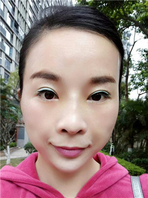 你們來(lái)看看我的面部埋埋蛋白線.提升術(shù)恢復(fù)情況