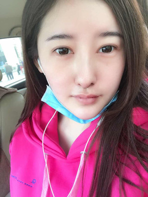 自體耳軟骨隆鼻果圖片展示和案例分享