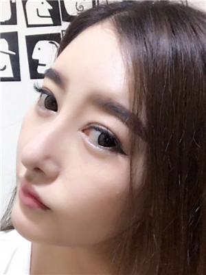 自體耳軟骨隆鼻果圖片展示和案例分享