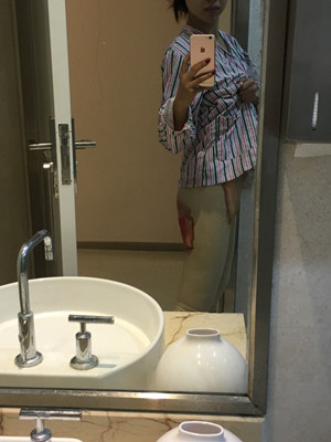 武漢同濟(jì)馮幼平水動(dòng)力吸脂瘦大腿前后對(duì)比照片~真實(shí)案例圖分享